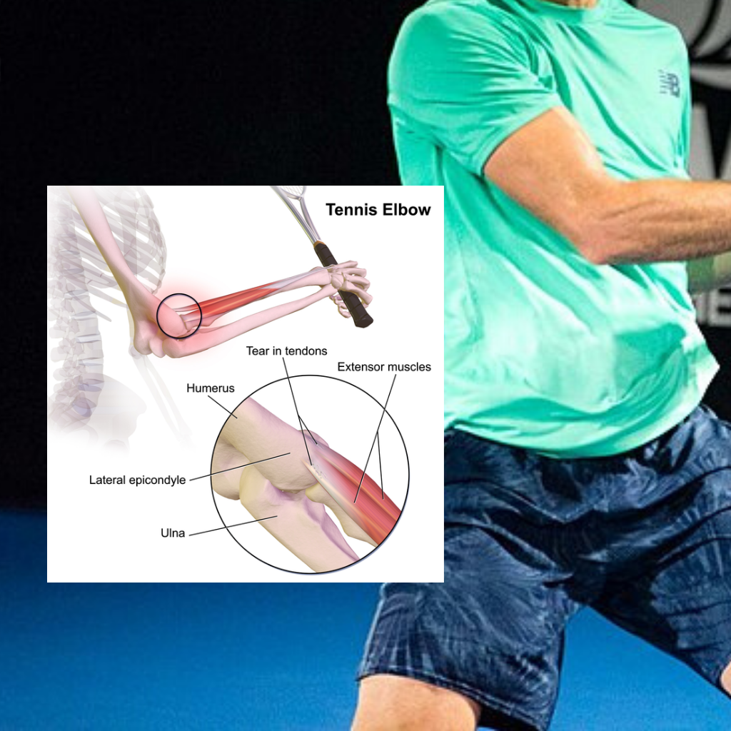 Tennis Elbow - 5 Simple Exercises To Cure Your Tennis Elbow And Get You Back Playing Tennis